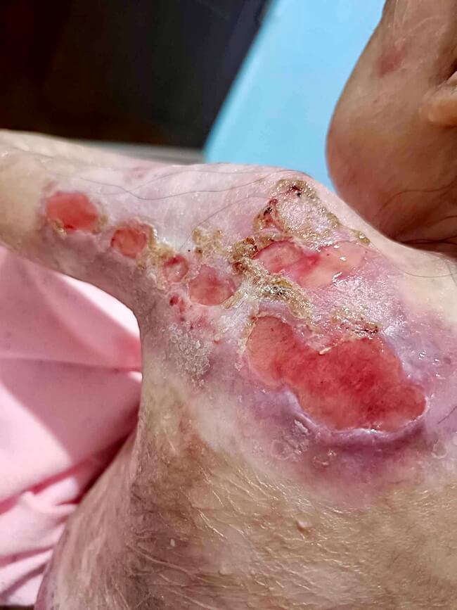 Delicate wound dressing