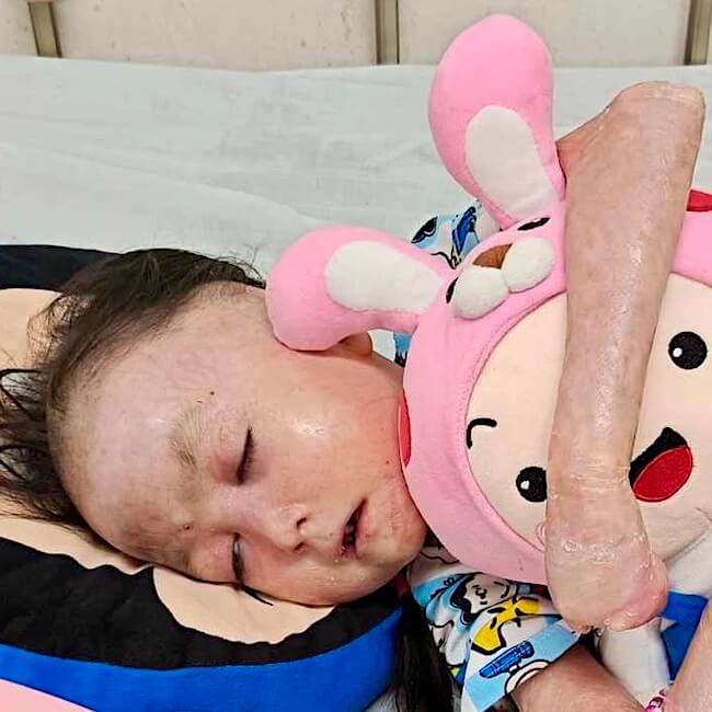 Shamila resting after treatment