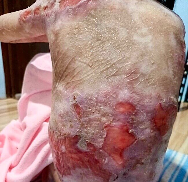 Severe skin detachment on limbs